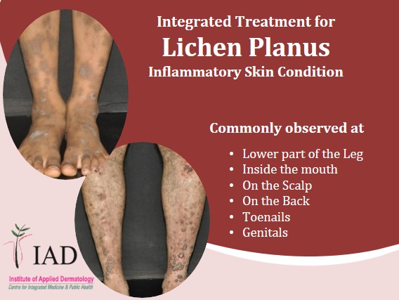 Integrative Treatment for Lichen Planus