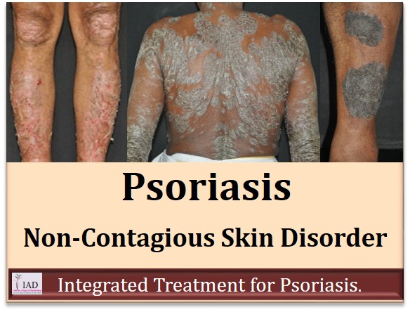 Integrated Treatment for Psoriasis